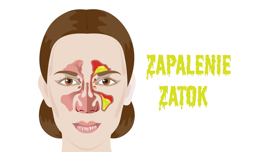 Zapalenie Zatok • Objawy I Leczenie • Laryngolog • Veritamed Warszawa 5875